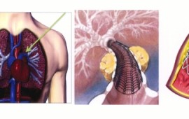 טיפול חדשני למומי לב מולדים: סטנט חדש יגדל עם המטופל