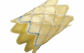 לראשונה בשיבא: השתלת מסתם ריאתי בצנתור לילדים ולמתבגרים