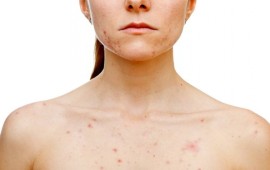 איך מטפלים באקנה בחזה? קרדיט תמונה Depositphotos