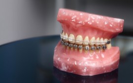 יישור שיניים שקוף קרדיט תמונה FREEPIK