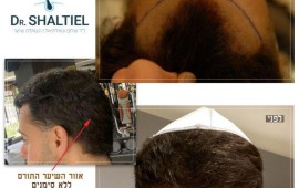 כיצד מבצעים התאמת טיפול השתלת שיער למטופל במרפאתו של ד"ר שאלתיאל? קרדיט לתמונות – בוסט מדיה